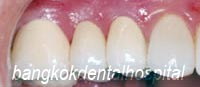 After Lumineers veneer treatment