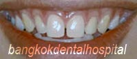 before Lumineers veneer treatment