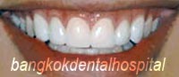 After Lumineers veneer treatment