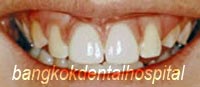 After Lumineers veneer treatment