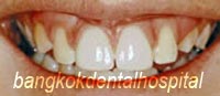 After Lumineers veneer treatment