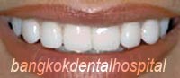 After Lumineers veneer treatment