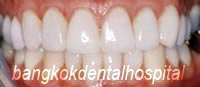 After Lumineers veneer treatment