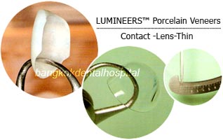 lumineers porcelain veneers dental clinic in bangkok thailand