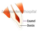 dental veneers clinic bangkok thailand