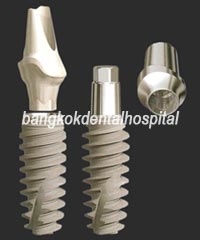 Nobel Active Dental Implant Bangkok Thailand Dental Clinic