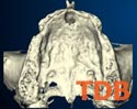 Dental Implant Thailand  NobelGuide 