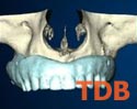 NobelGuide implant system