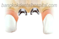 NobelPerfect Dental Implants Bangkok, NobelPerfect Dental Implants Thailand, nobel perfect center