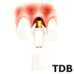 NobelReplace Tapered Groovy Implants, Procera Abutment , Procera; Crown