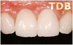 NobelRondo alumina crowns veneers - after