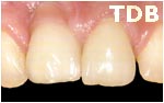 NobelRondo alumina crowns veneers - before