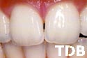 NobelRondo bangkok - natural teeth
