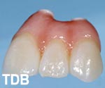 NobelRondo alumina procera crowns - before