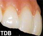 NobelRondo alumina procera crowns - after