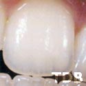 NobelRondo thailand - natural teeth