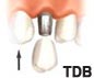 one day implant immediate function implant at bangkok dental hospital