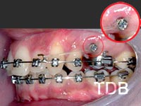 orthodontic mini-screw