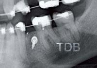 x-ray showing a mini-screw