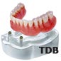 dental implants for edentulous jaw : implant+locator abutment+overdenture