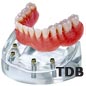 dental implants for edentulous jaw : implant+locator abutment+overdenture