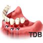 dental implants for edentulous jaw : 6 implants+ 10 unit bridges