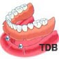 dental implants for edentulous jaw : implant+ball+overdenture
