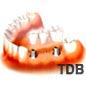 2 dental implants+ 3 unit bridges