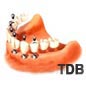 dental implants for edentulous jaw : 6 implants+ 12 unit bridges