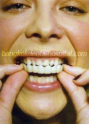 snap-on smile bangkok, snap-on smile thailand