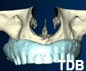 teeth-in-an-hour treatment implant dental center