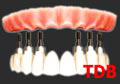 Teeth-in-an-Hour, all-on-4+NobelGuide+Titanium+Acylic bridges 