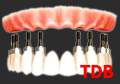 teeth-in-an-hour : 8 NobelReplace Groovy + 12 unit Procera Zirconia framework + NobelRondo porcelain
