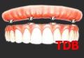 Teeth-in-an-Hour, all-on-4+NobelGuide+Titanium+Acylic bridges 