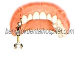 teeth-in-an-hour in dental implant bangkok