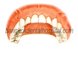 teeth-in-an-hour in dental dental implant thailand