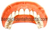 teeth-in-an-hour in dental thailand