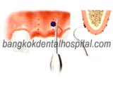 NobelGuide in dental clinic bangkok