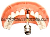 teeth-in-an-hour in dental bangkok