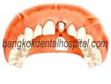 teeth-in-an-hour in dental thailand