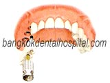 teeth-in-an-hour in dental bangkok