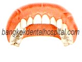 teeth-in-an-hour in dental thailand