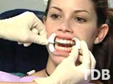 zoom teeth whitening dental clinic, zoom whitening system dental clinic