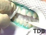 zoom teeth whitening thailand dental, zoom teeth whitening bangkok dental