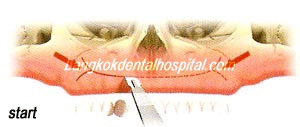 zygoma implant in dental bangkok, zygoma implant in dental thailand