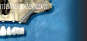 zygoma implant for extreme cases with severe bone resorption