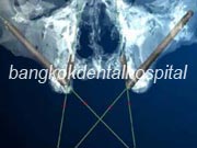 Branemark system Zygoma with NobelGuide Bangkok