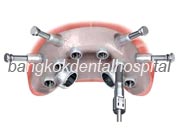 Branemark system Zygoma with NobelGuide Bangkok