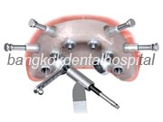 Branemark system Zygoma with NobelGuide Bangkok