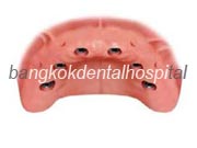 Branemark system Zygoma with NobelGuide Thailand